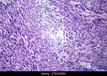 Photomicrograph of leiomyoma, illustrating benign smooth muscle tumor cells within the uterine tissue. Stock Photo