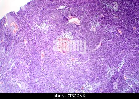 Photomicrograph of leiomyoma, illustrating benign smooth muscle tumor cells within the uterine tissue. Stock Photo