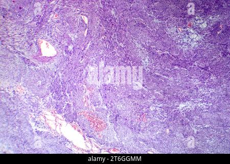 Photomicrograph of leiomyoma, illustrating benign smooth muscle tumor cells within the uterine tissue. Stock Photo