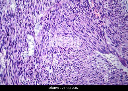 Photomicrograph of leiomyoma, illustrating benign smooth muscle tumor cells within the uterine tissue. Stock Photo