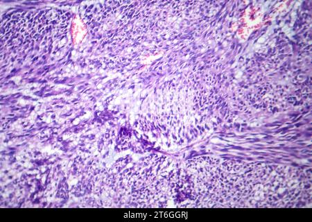 Photomicrograph of leiomyoma, illustrating benign smooth muscle tumor cells within the uterine tissue. Stock Photo