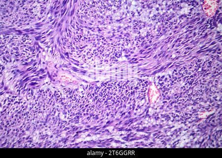 Photomicrograph of leiomyoma, illustrating benign smooth muscle tumor cells within the uterine tissue. Stock Photo