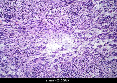 Photomicrograph of leiomyoma, illustrating benign smooth muscle tumor cells within the uterine tissue. Stock Photo