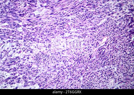 Photomicrograph of leiomyoma, illustrating benign smooth muscle tumor cells within the uterine tissue. Stock Photo