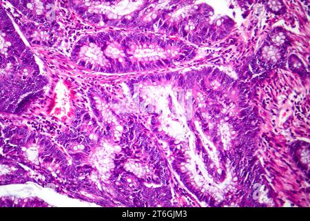 Photomicrograph of colon adenocarcinoma, illustrating malignant glandular cells characteristic of colon cancer. Stock Photo
