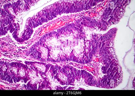 Photomicrograph of colon adenocarcinoma, illustrating malignant glandular cells characteristic of colon cancer. Stock Photo