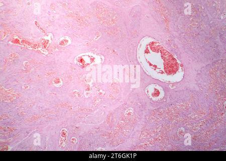 Photomicrograph of capillary hemangioma, illustrating abnormal ...