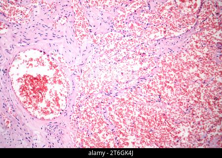 Photomicrograph of capillary hemangioma, illustrating abnormal ...