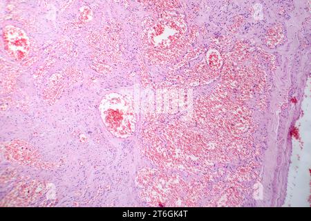 Photomicrograph of capillary hemangioma, illustrating abnormal ...