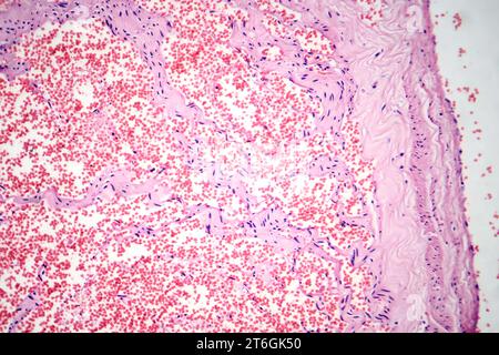 Photomicrograph of capillary hemangioma, illustrating abnormal ...