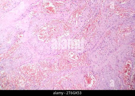 Photomicrograph of capillary hemangioma, illustrating abnormal ...