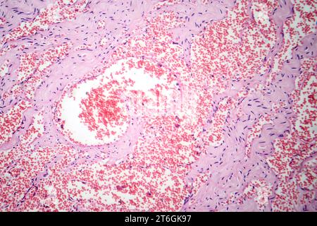 Photomicrograph of capillary hemangioma, illustrating abnormal ...