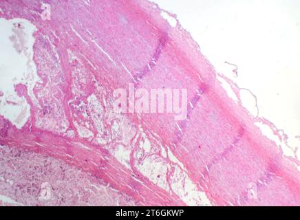 Photomicrograph of fibrinoid necrosis in a vessel wall, displaying damaged vessel integrity and immune response-related changes. Stock Photo