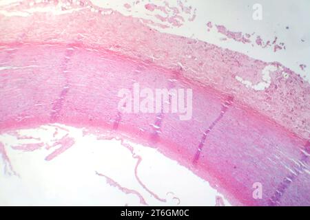 Photomicrograph of fibrinoid necrosis in a vessel wall, displaying damaged vessel integrity and immune response-related changes. Stock Photo