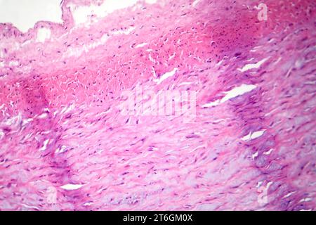 Photomicrograph of fibrinoid necrosis in a vessel wall, displaying damaged vessel integrity and immune response-related changes. Stock Photo