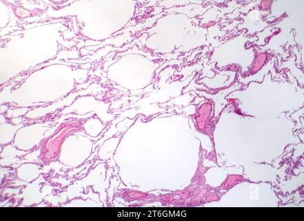 Photomicrograph of diffuse emphysema, revealing damaged lung tissue with enlarged airspaces, characteristic of chronic obstructive pulmonary disease ( Stock Photo