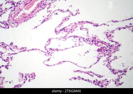 Photomicrograph of diffuse emphysema, revealing damaged lung tissue with enlarged airspaces, characteristic of chronic obstructive pulmonary disease ( Stock Photo