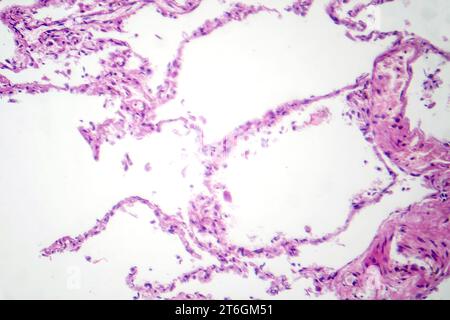 Photomicrograph of diffuse emphysema, revealing damaged lung tissue with enlarged airspaces, characteristic of chronic obstructive pulmonary disease ( Stock Photo