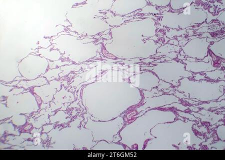 Photomicrograph of diffuse emphysema, revealing damaged lung tissue with enlarged airspaces, characteristic of chronic obstructive pulmonary disease ( Stock Photo