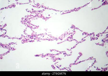 Photomicrograph of diffuse emphysema, revealing damaged lung tissue with enlarged airspaces, characteristic of chronic obstructive pulmonary disease ( Stock Photo