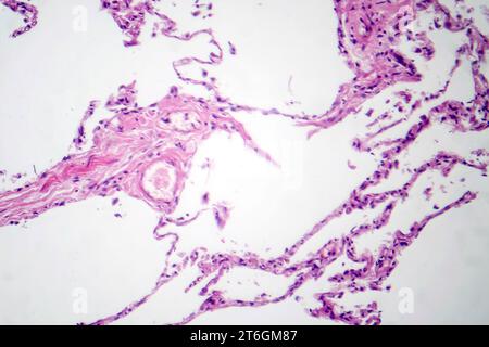 Photomicrograph of diffuse emphysema, revealing damaged lung tissue with enlarged airspaces, characteristic of chronic obstructive pulmonary disease ( Stock Photo