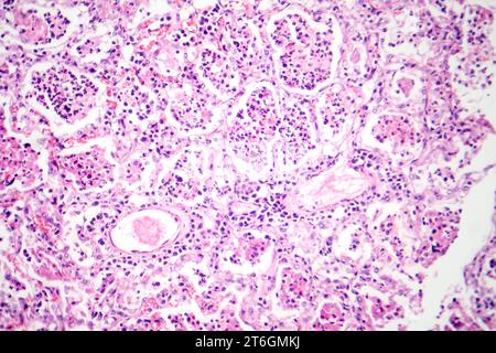 Photomicrograph of lobar pneumonia in red hepatic phase, displaying ...