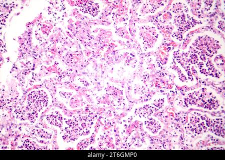 Photomicrograph of lobar pneumonia in red hepatic phase, displaying ...