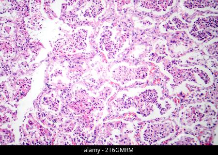 Photomicrograph of lobar pneumonia in red hepatic phase, displaying ...