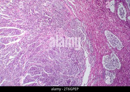 Photomicrograph of small cell lung cancer, revealing densely packed malignant cells characteristic of an aggressive lung malignancy. Stock Photo