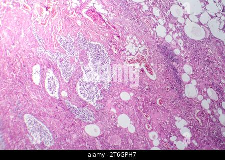 Photomicrograph of small cell lung cancer, revealing densely packed malignant cells characteristic of an aggressive lung malignancy. Stock Photo