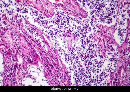 Photomicrograph of small cell lung cancer, revealing densely packed malignant cells characteristic of an aggressive lung malignancy. Stock Photo