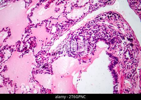 Photomicrograph of lung adenocarcinoma, displaying malignant glandular