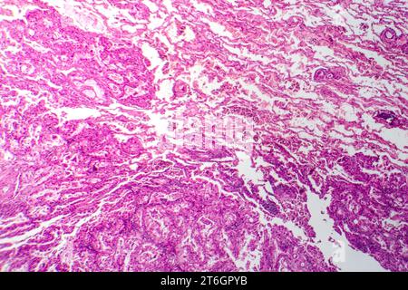 Photomicrograph of lung cancer tissue, revealing malignant cells and the abnormal growth characteristic of lung malignancy. Stock Photo