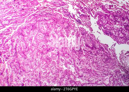 Photomicrograph of lung cancer tissue, revealing malignant cells and the abnormal growth characteristic of lung malignancy. Stock Photo