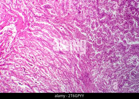 Photomicrograph of lung cancer tissue, revealing malignant cells and the abnormal growth characteristic of lung malignancy. Stock Photo