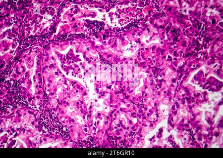 Photomicrograph of lung cancer tissue, revealing malignant cells and the abnormal growth characteristic of lung malignancy. Stock Photo