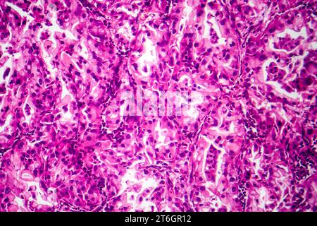 Photomicrograph of lung cancer tissue, revealing malignant cells and the abnormal growth characteristic of lung malignancy. Stock Photo