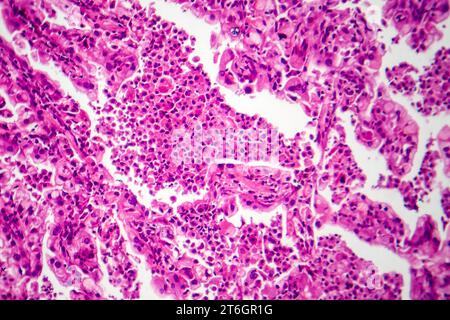 Photomicrograph of lung cancer tissue, revealing malignant cells and the abnormal growth characteristic of lung malignancy. Stock Photo