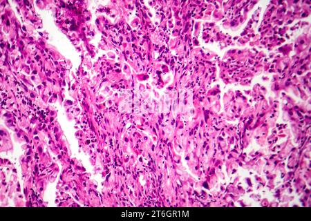 Photomicrograph of lung cancer tissue, revealing malignant cells and the abnormal growth characteristic of lung malignancy. Stock Photo