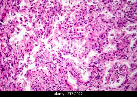 Photomicrograph of lung cancer tissue, revealing malignant cells and the abnormal growth characteristic of lung malignancy. Stock Photo