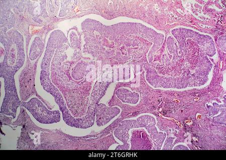 Photomicrograph of lung adenocarcinoma, illustrating malignant glandular cells characteristic of the most common type of lung cancer. Stock Photo