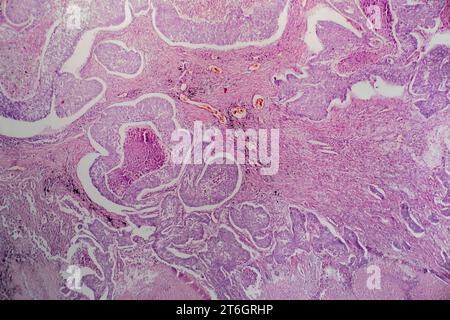 Photomicrograph of lung adenocarcinoma, illustrating malignant glandular cells characteristic of the most common type of lung cancer. Stock Photo