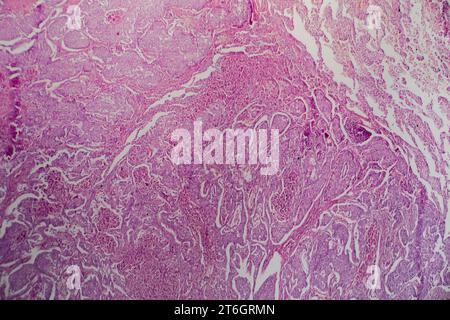 Photomicrograph of lung adenocarcinoma, illustrating malignant glandular cells characteristic of the most common type of lung cancer. Stock Photo