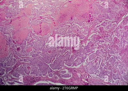 Photomicrograph of lung adenocarcinoma, illustrating malignant glandular cells characteristic of the most common type of lung cancer. Stock Photo