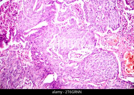 Photomicrograph of lung adenocarcinoma, illustrating malignant glandular cells characteristic of the most common type of lung cancer. Stock Photo