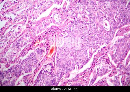 Photomicrograph of lung adenocarcinoma, illustrating malignant glandular cells characteristic of the most common type of lung cancer. Stock Photo