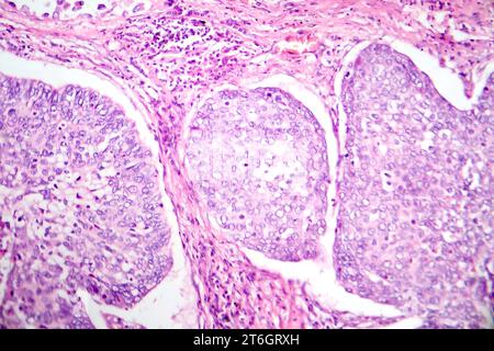 Photomicrograph of lung adenocarcinoma, illustrating malignant glandular cells characteristic of the most common type of lung cancer. Stock Photo