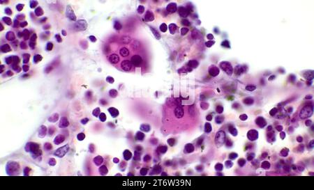 Osteoclasts. Two osteoclasts in red bone marrow. Hematoxylin and eosin staining. Magnification - 1000. Stock Photo