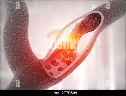 Atherosclerosis, Cholesterol plaque in artery. 3d illustration Stock Photo