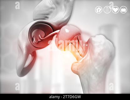 Hip replacement on medical background. 3d illustration Stock Photo